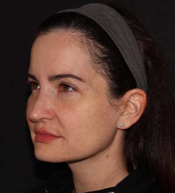 Facelift Before & After Gallery - Patient 121763167 - Image 5