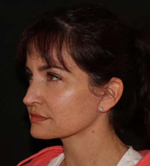 Facelift Before & After Gallery - Patient 121763167 - Image 6
