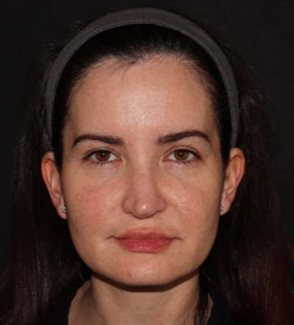 Facelift Before & After Gallery - Patient 121763167 - Image 1