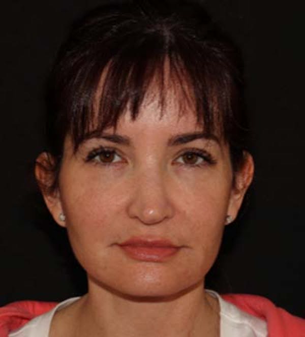 Facelift Before & After Gallery - Patient 121763167 - Image 2