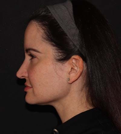 Facelift Before & After Gallery - Patient 121763167 - Image 9
