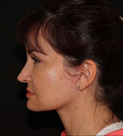 Facelift Before & After Gallery - Patient 121763167 - Image 10