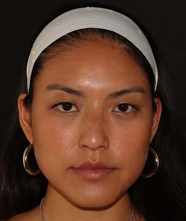 Liquid Rhinoplasty Before & After Gallery - Patient 121989680 - Image 1