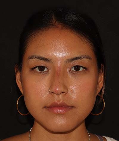 Liquid Rhinoplasty Before & After Gallery - Patient 121989680 - Image 2