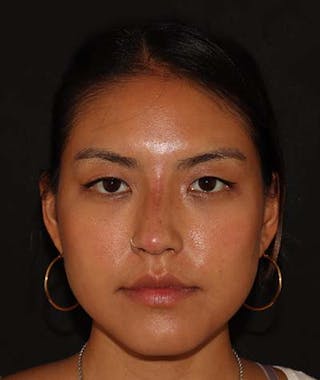 Liquid Rhinoplasty Before & After Gallery - Patient 121989680 - Image 2