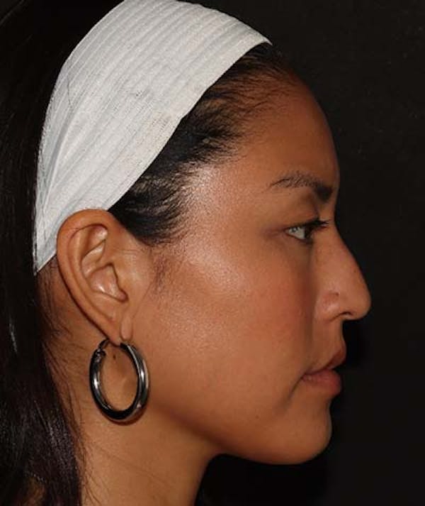 Liquid Rhinoplasty Before & After Gallery - Patient 121989680 - Image 3