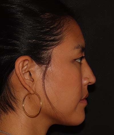 Liquid Rhinoplasty Before & After Gallery - Patient 121989680 - Image 4