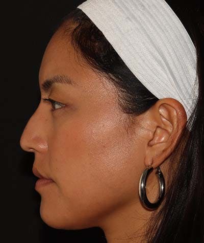 Liquid Rhinoplasty Before & After Gallery - Patient 121989680 - Image 5