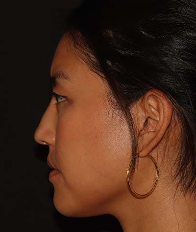 Liquid Rhinoplasty Before & After Gallery - Patient 121989680 - Image 6