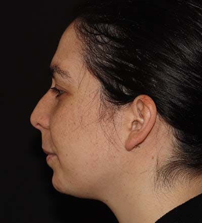 Chin Filler Gallery - Patient 141186476 - Image 3