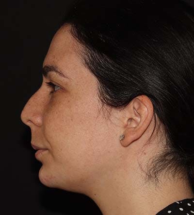 Chin Filler Before & After Gallery - Patient 141186476 - Image 4