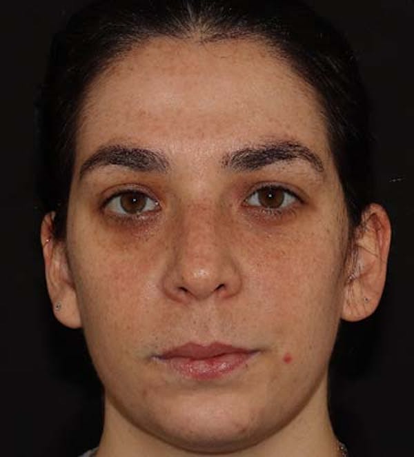 Chin Filler Before & After Gallery - Patient 141186476 - Image 1