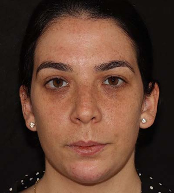 Injectables Gallery - Patient 122030467 - Image 2