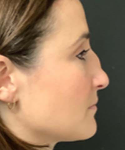 Rhinoplasty Before & After Gallery - Patient 122161031 - Image 3