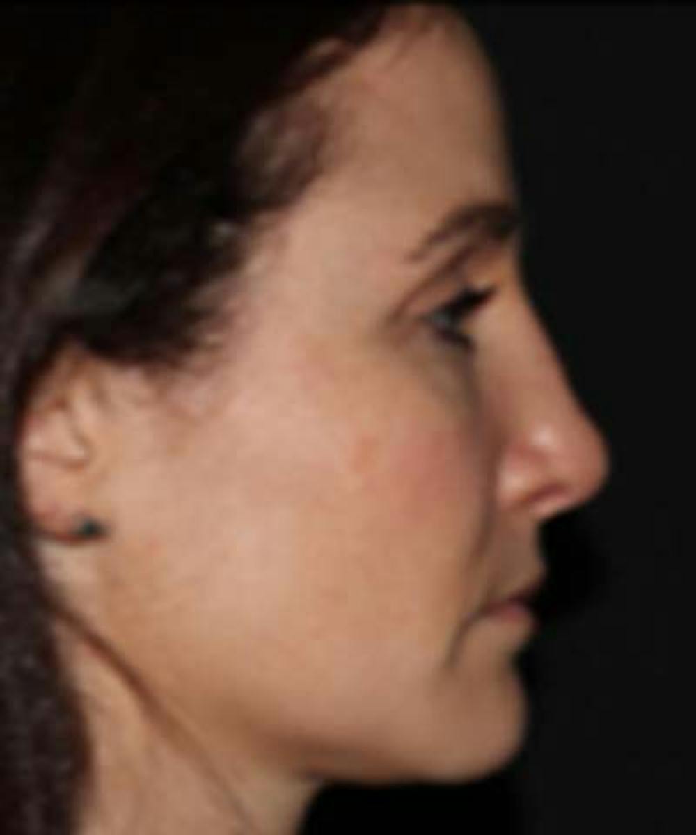 Rhinoplasty Before & After Gallery - Patient 122161031 - Image 4