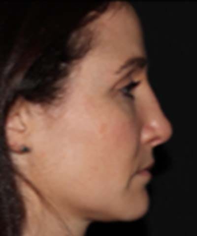 Rhinoplasty Before & After Gallery - Patient 122161031 - Image 4