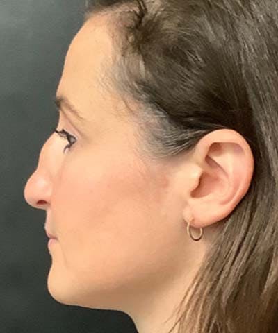 Rhinoplasty Before & After Gallery - Patient 122161031 - Image 1