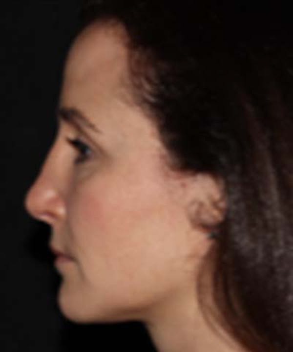 Rhinoplasty Before & After Gallery - Patient 122161031 - Image 2