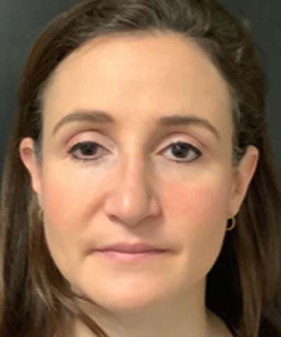 Rhinoplasty Before & After Gallery - Patient 122161031 - Image 5