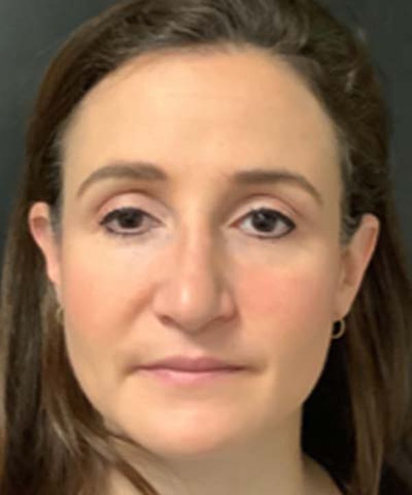 Rhinoplasty Before & After Gallery - Patient 122161031 - Image 5