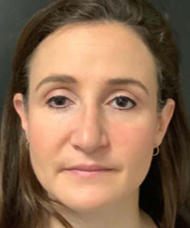 Rhinoplasty Before & After Gallery - Patient 122161031 - Image 5