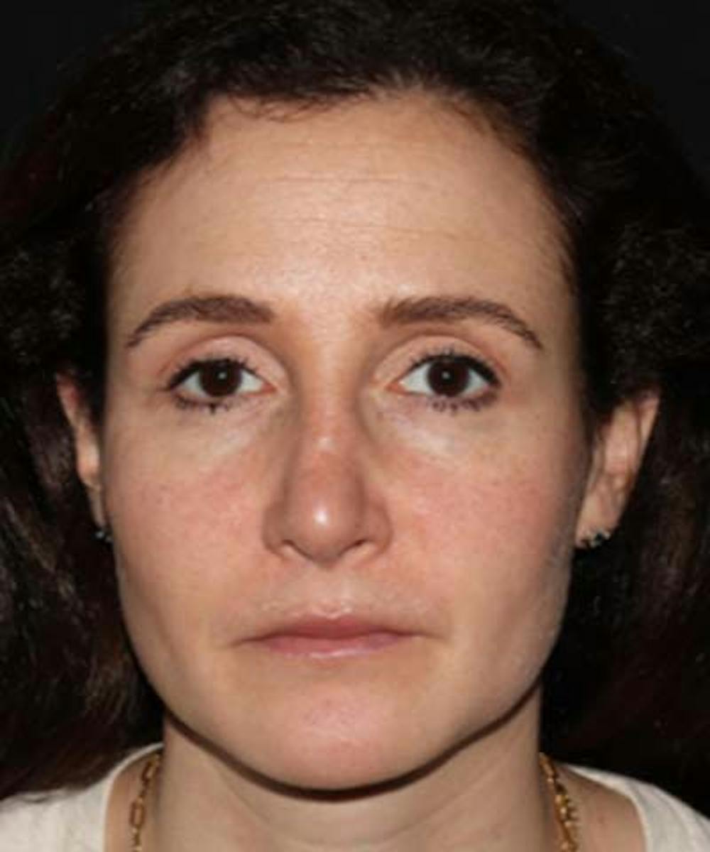 Rhinoplasty Before & After Gallery - Patient 122161031 - Image 6