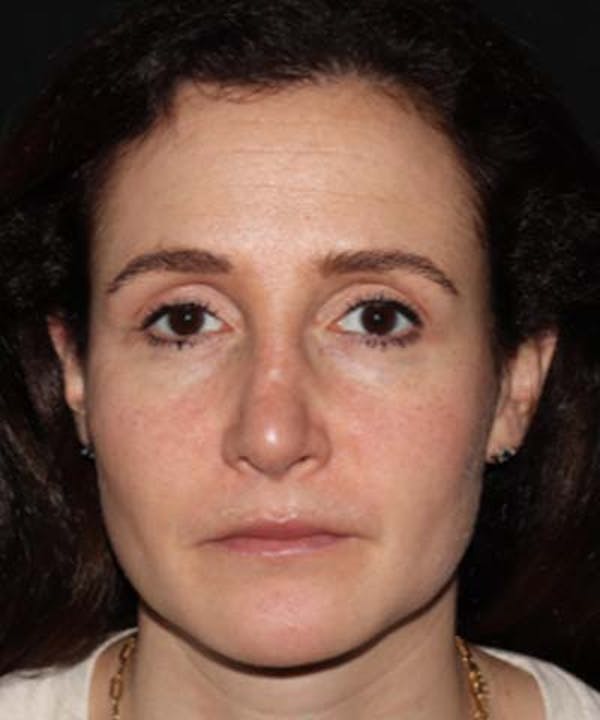 Rhinoplasty Before & After Gallery - Patient 122161031 - Image 6