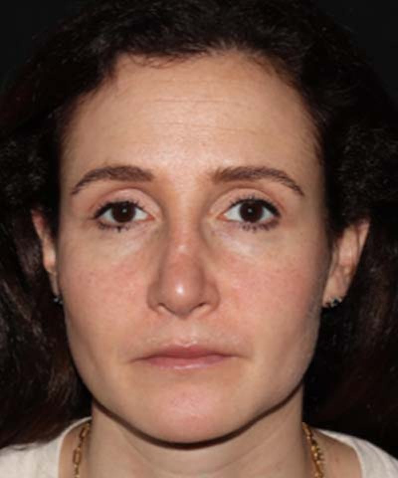 Rhinoplasty Before & After Gallery - Patient 122161031 - Image 6