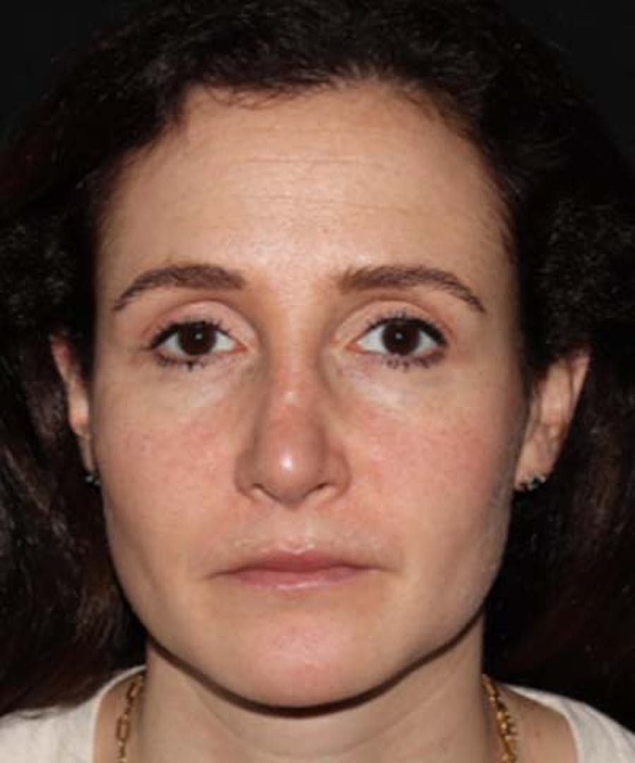 Rhinoplasty Before & After Gallery - Patient 122161031 - Image 6