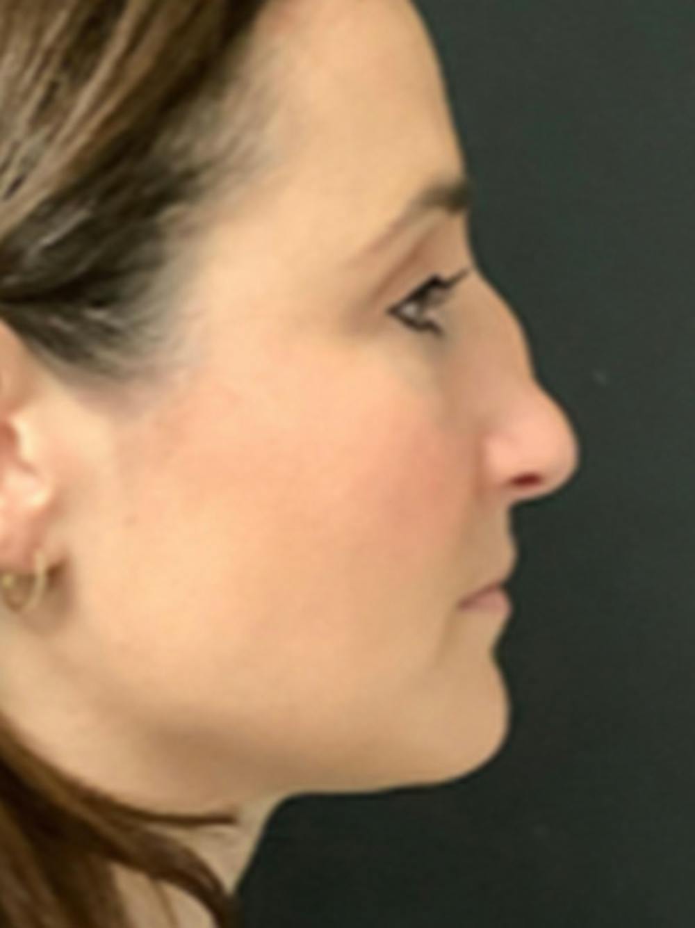 Rhinoplasty Before & After Gallery - Patient 122792541 - Image 1