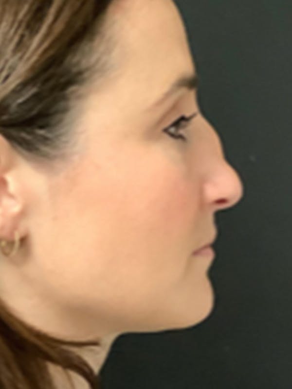 Rhinoplasty Before & After Gallery - Patient 122792541 - Image 1