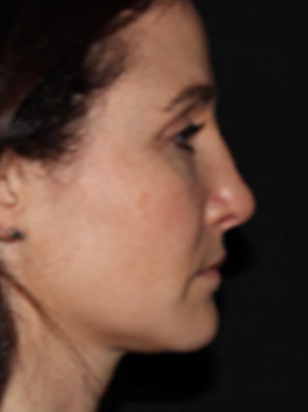 Rhinoplasty Before & After Gallery - Patient 122792541 - Image 2