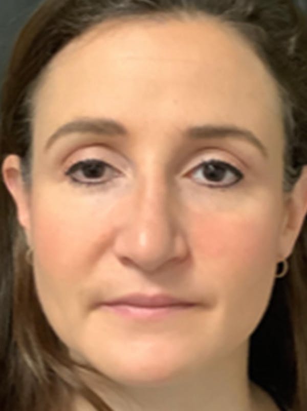 Rhinoplasty Before & After Gallery - Patient 122792541 - Image 3