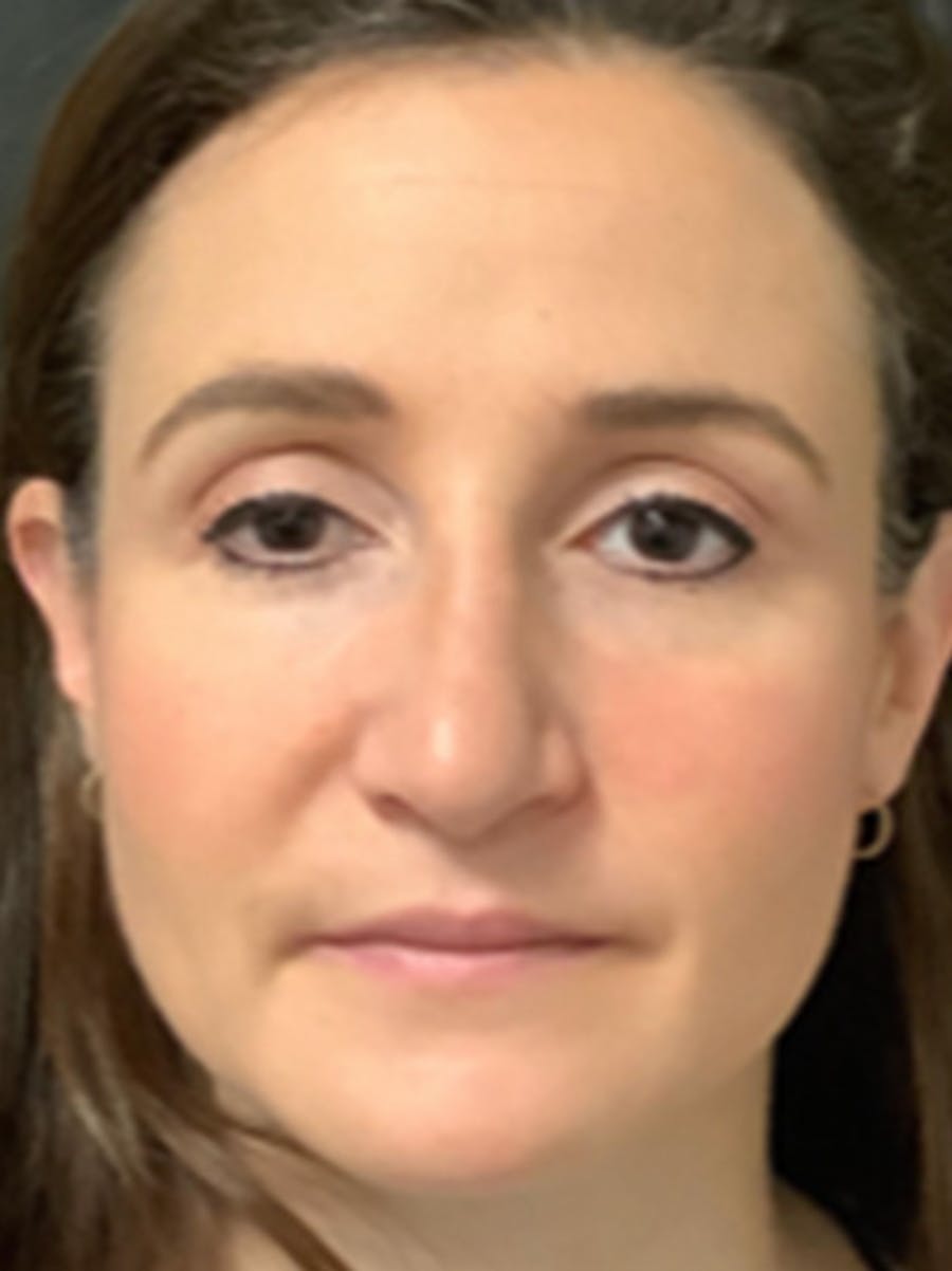 Rhinoplasty Before & After Gallery - Patient 122792541 - Image 3