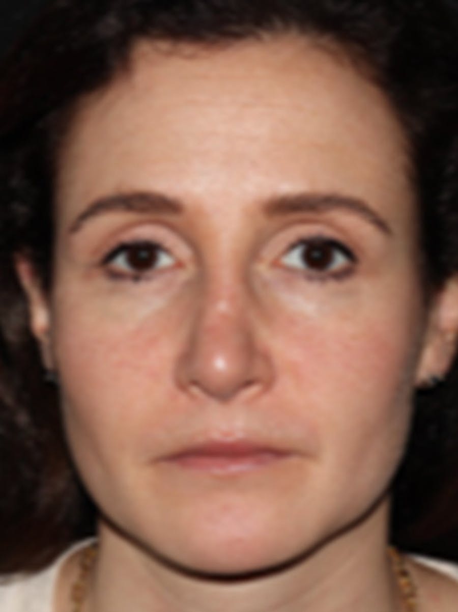 Rhinoplasty Before & After Gallery - Patient 122792541 - Image 4