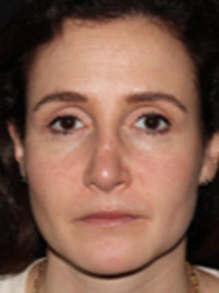 Rhinoplasty Before & After Gallery - Patient 122792541 - Image 4