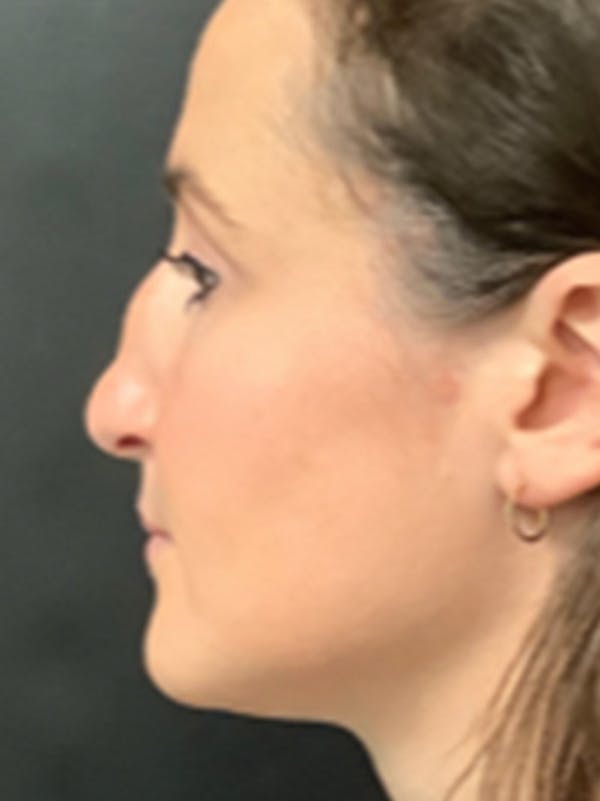 Rhinoplasty Before & After Gallery - Patient 122792541 - Image 5