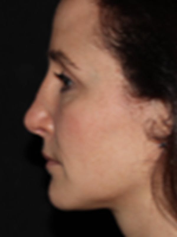 Rhinoplasty Before & After Gallery - Patient 122792541 - Image 6