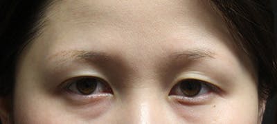 eyebrow transplant