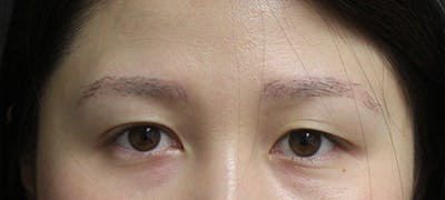 eyebrow transplant