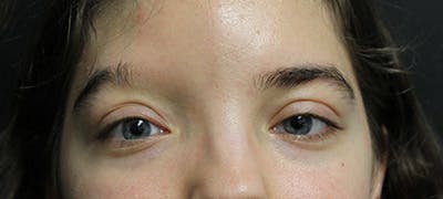 eyebrow transplant