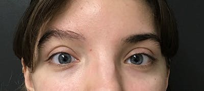 eyebrow transplant