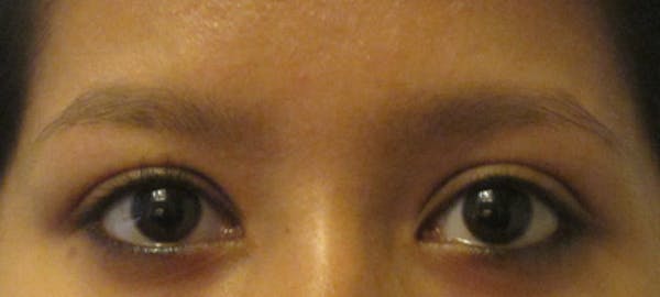 Eyebrow Transplant Before & After Gallery - Patient 122877798 - Image 1