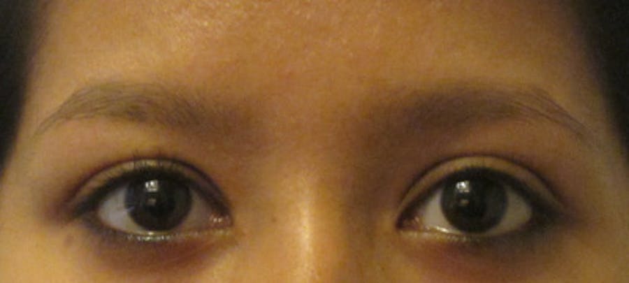 Eyebrow Transplant Before & After Gallery - Patient 122877798 - Image 1