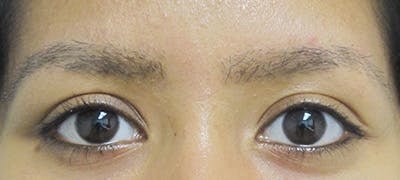 Eyebrow Transplant Before & After Gallery - Patient 122877798 - Image 2