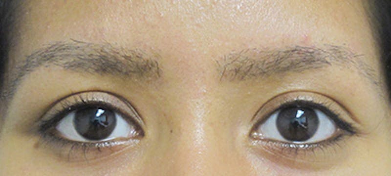 Eyebrow Transplant Before & After Gallery - Patient 122877798 - Image 2
