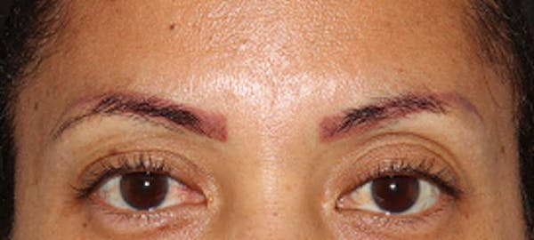 Eyebrow Transplant Before & After Gallery - Patient 122877799 - Image 1