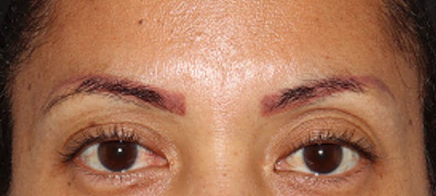 Eyebrow Transplant Before & After Gallery - Patient 122877799 - Image 1