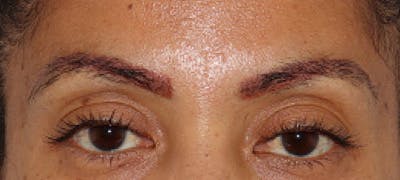 Eyebrow Transplant Before & After Gallery - Patient 122877799 - Image 2