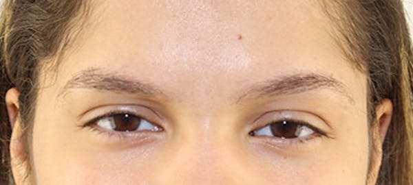 Eyebrow Transplant Before & After Gallery - Patient 122877800 - Image 1